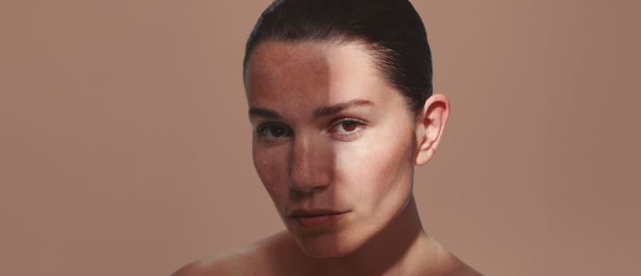 Depigmentation treatment — RT Skin Glow Clinic Eastleigh and Verwood