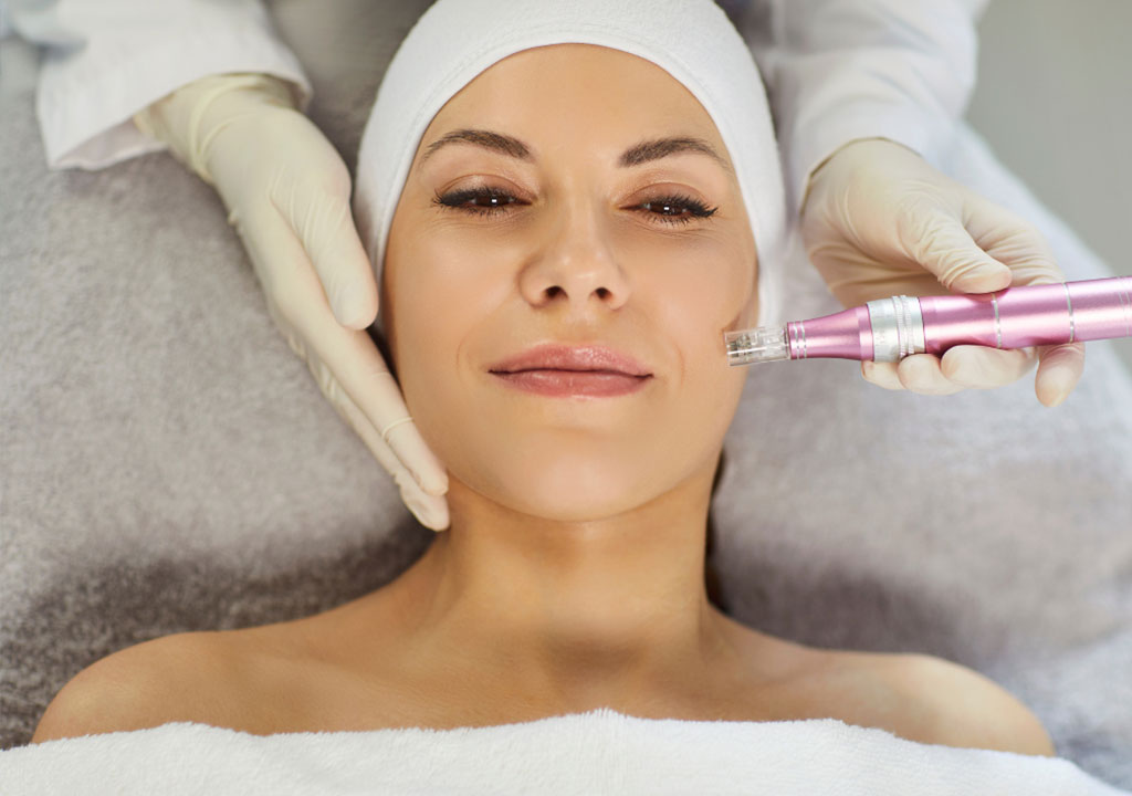 Microneedling acne scar treatment Eastleigh