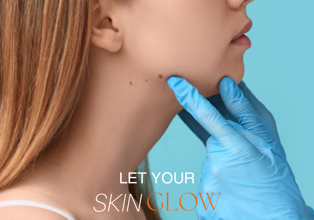 Mole removal in Eastleigh skin clinic