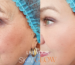 pigmentation-treatment-eastleigh-southampton